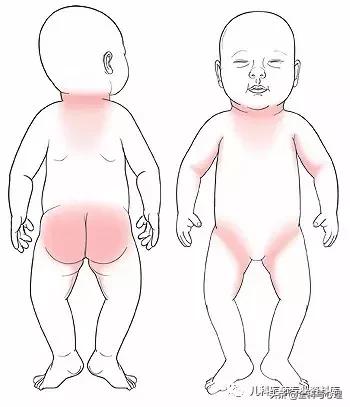儿童痱子和湿疹，千万要分清楚了
