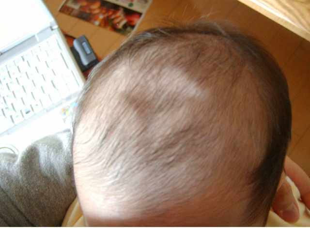 小孩脑袋凹进去一块,小孩头凹下去一圈