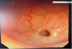 肠穿孔非手术治疗措施,结肠穿孔治疗视频
