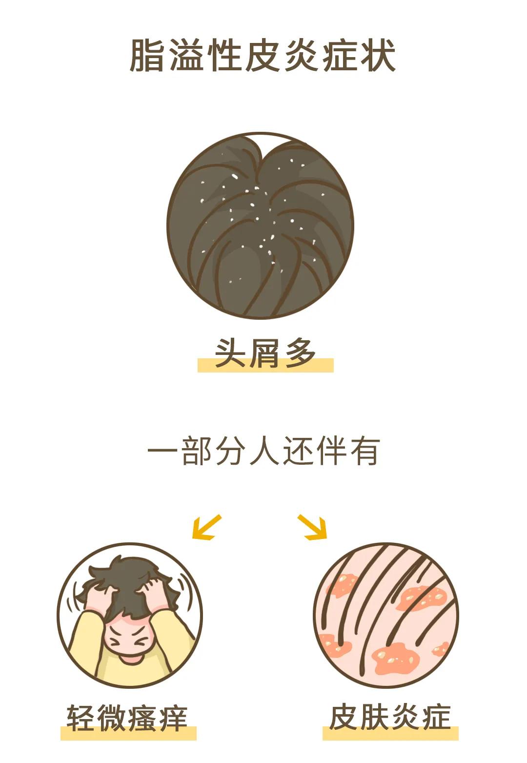 冬天为什么会有头皮屑,为什么头皮屑越挠越多