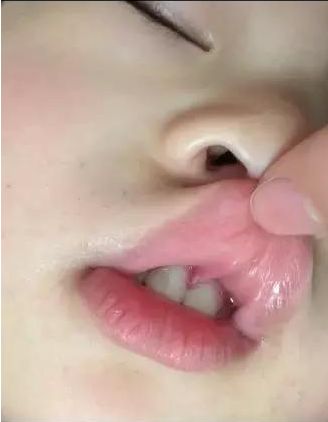 换牙两个门牙之间两毫米缝隙,儿童换牙两门牙中间缝隙大