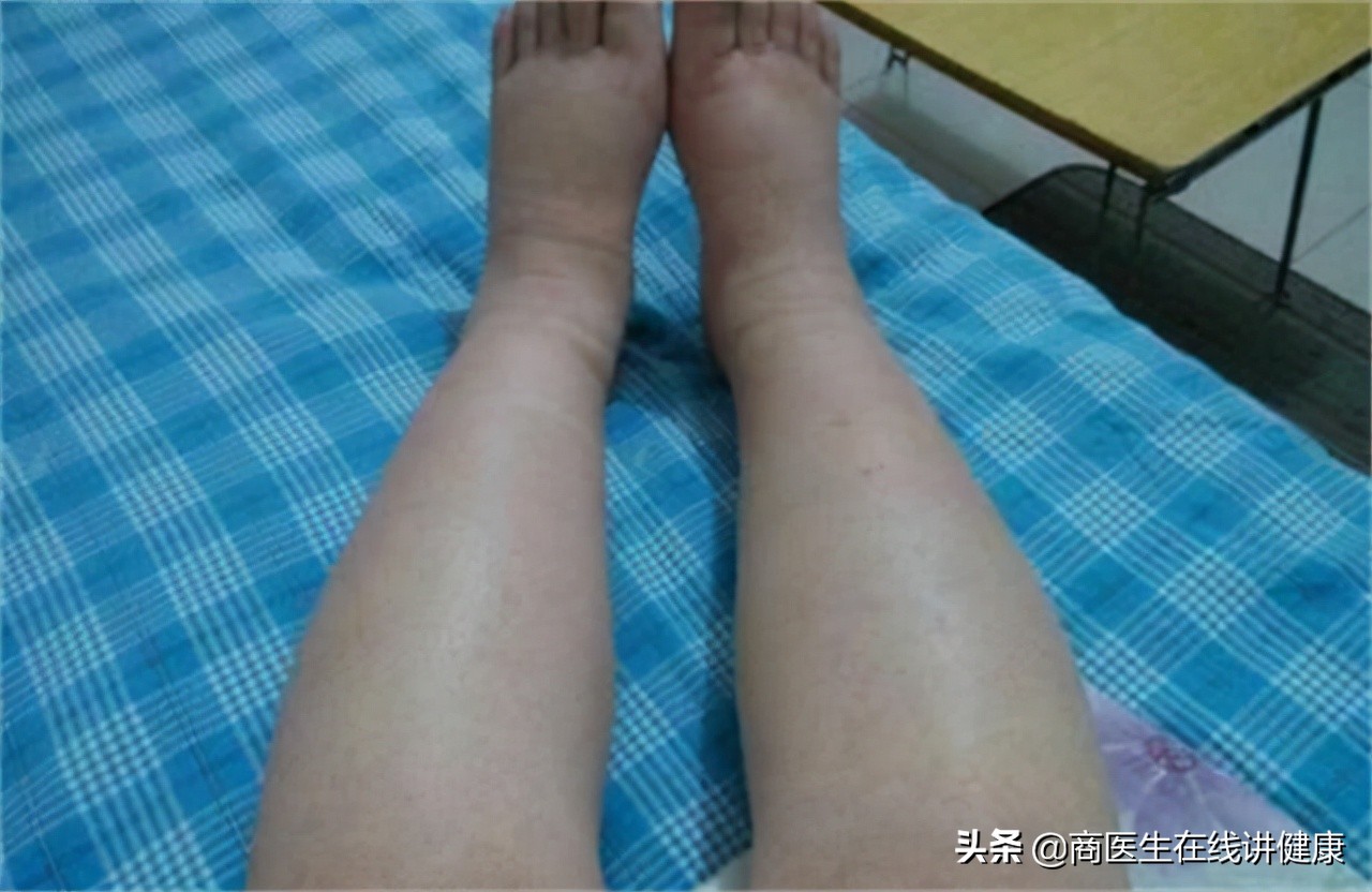 糖尿病伤着肾吃什么药最好,糖尿病损伤神经吃点什么药