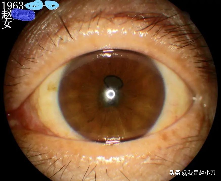 虹膜炎瞳孔已经粘连了怎么办,虹膜炎瞳孔粘连打针需要几次