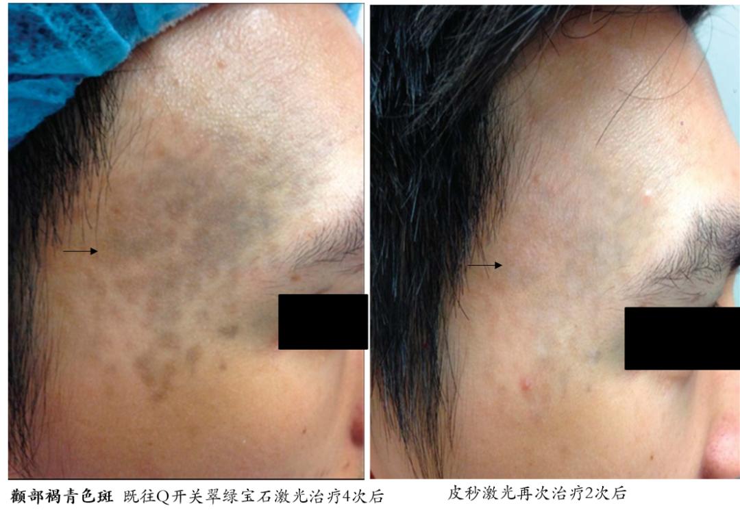 皮秒激光祛斑能保护表皮不受损伤,超皮秒激光祛斑的危害与效果视频