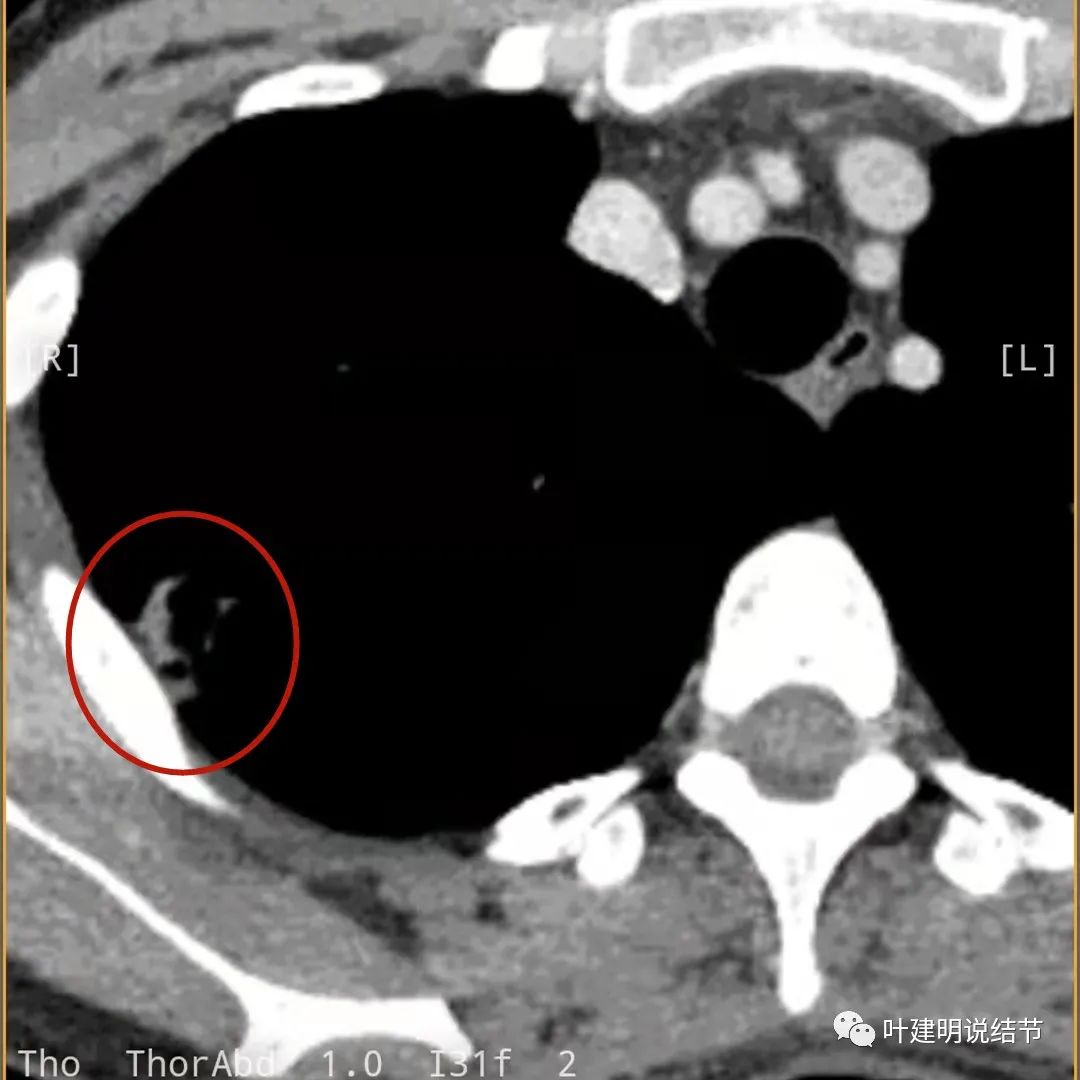 临床诊断孤立性肺结节,空洞型结节一般是什么性质
