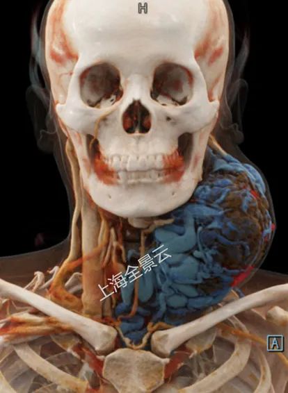 颈部肿块为什么有80%是肿瘤,颈部肿块1年没有变化