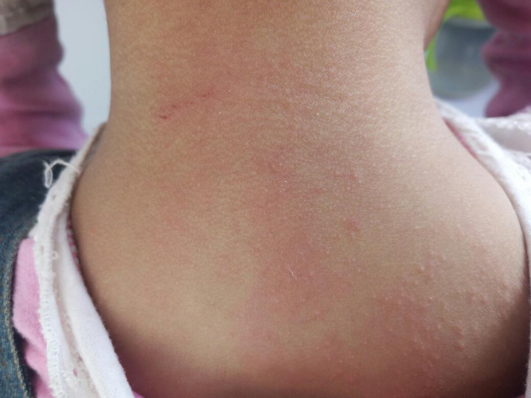 麦粒肿什么时候会出现白色脓点,麦粒肿反复发作是什么病的前兆