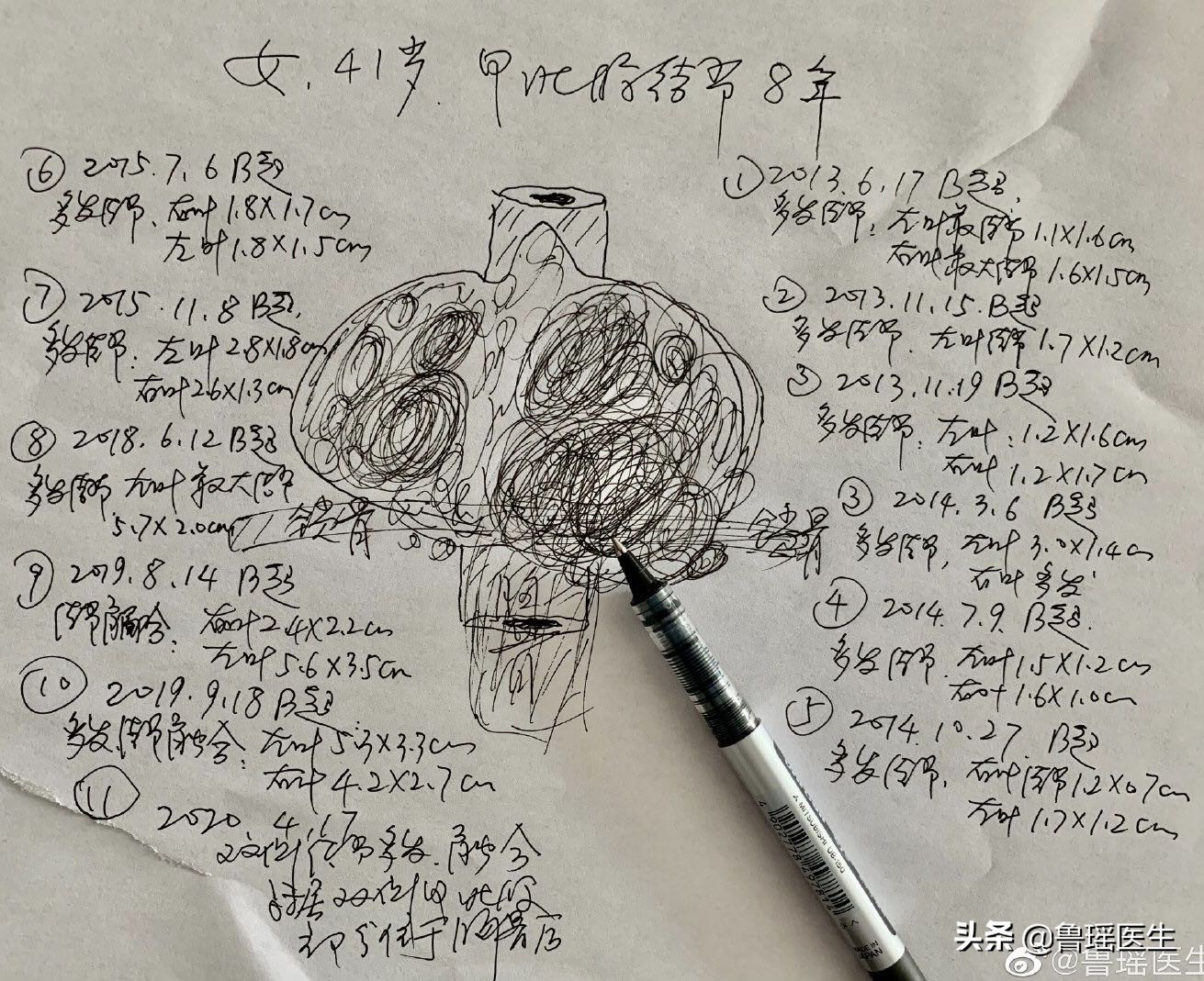 甲状腺结节从生长到发现要多久,甲状腺结节观察3个月会变大吗