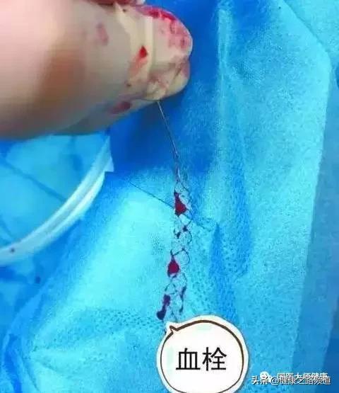 如何让身体不形成血栓,一个动作让血栓变好