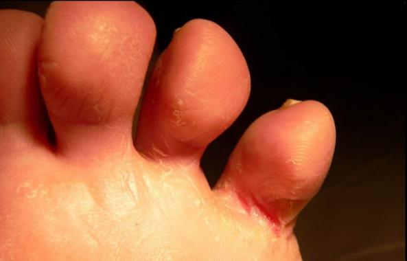 脚上有病有什么征兆,脚上有这三种症状赶紧去医院