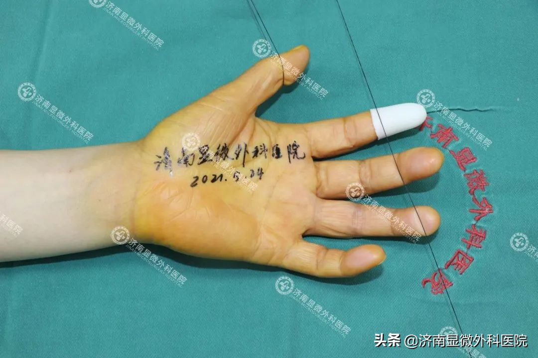 日本手指缺失修复,多年前断手指修复