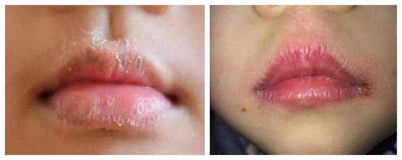 滋润保湿告别干燥起皮,保湿提亮肤色改善起皮防干裂