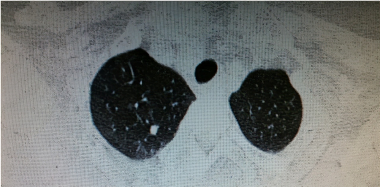 慢阻肺肺气肿的护理ppt,肺气肿不可逆怎么回事