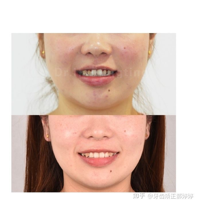 上海成人牙齿矫正失败案例,上海牙齿矫正郝婷婷医生