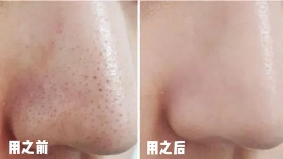 黑头毛孔粗大变细腻,皮肤黑头多毛孔大油脂分泌旺盛