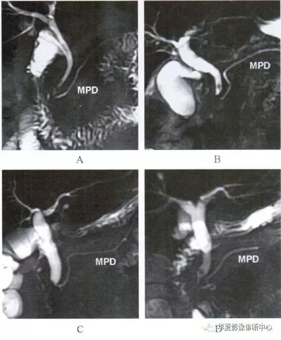 副胰管与主胰管图谱,主胰管型和分支胰管型如何鉴别