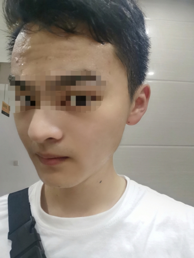 背部痘印黑色素沉淀怎么去除,痘痘痘印怎么去除