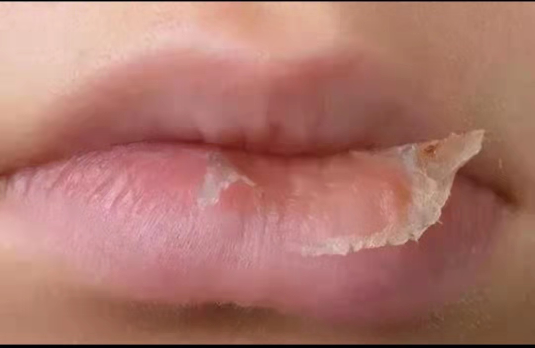 冬季孩子嘴唇起皮、干裂还出血?三招教你正确护理,光喝水没用