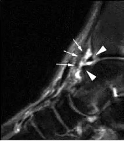 踝关节撞击症问诊,踝关节撞击综合征的x线表现