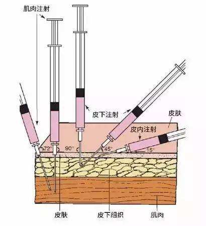 猪怎么打针最简单的方法,给猪打针如何正确拿注射器打针