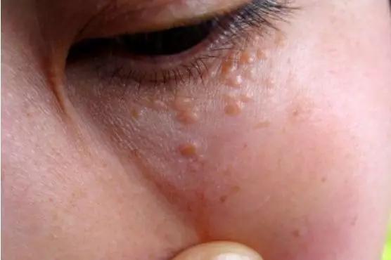 眼周脂肪粒可以激光去除吗,眼周脂肪粒会自动消失吗