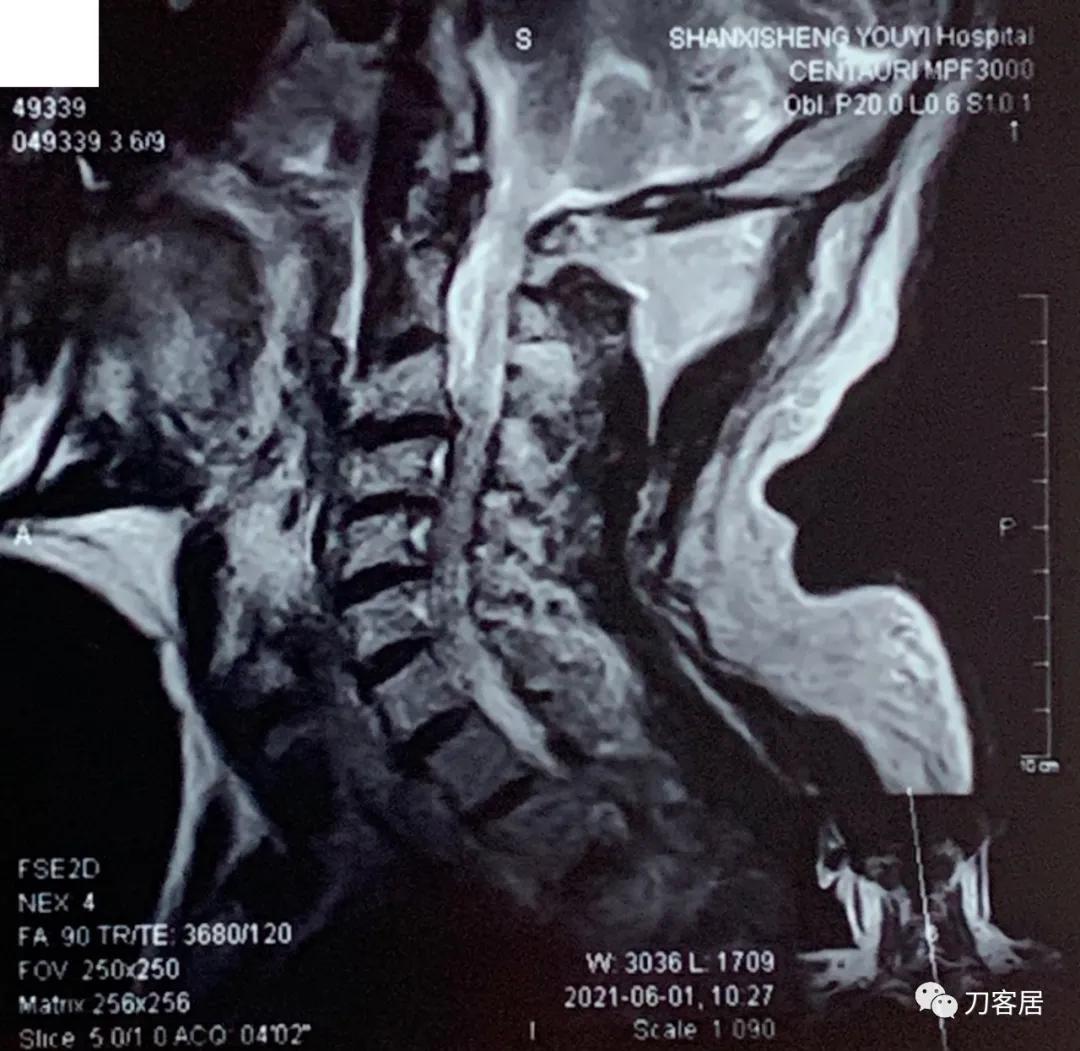 70岁男性，神经根型颈椎病，片子显示较严重，我依然先行保守治疗