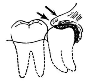 水平阻生智齿一定要拔掉吗,嘴里长了智齿一定要拔掉吗