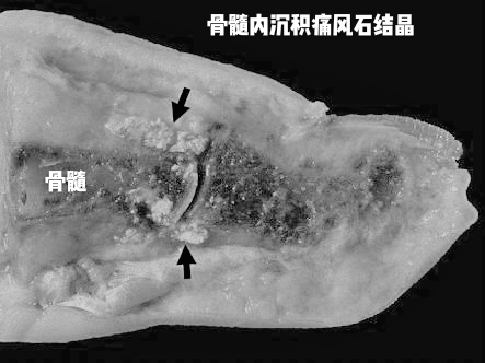 关节炎可以通过打抗生素治疗吗,关节炎治疗的注意事项