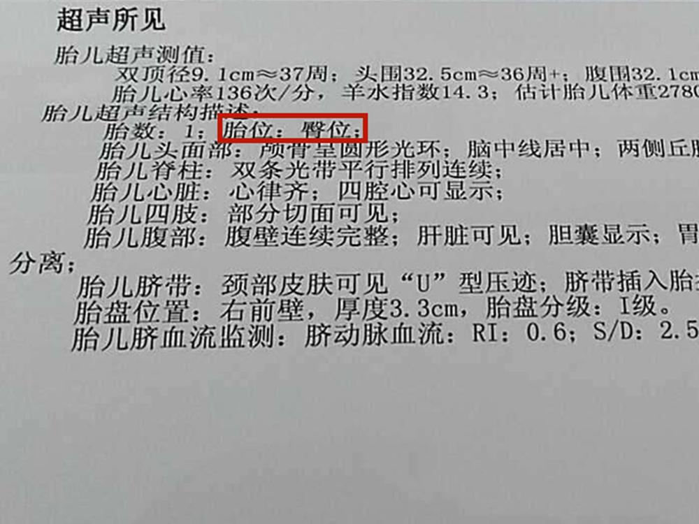 为什么会形成胎儿臀位？如何纠正？不妨学学这两个小技巧