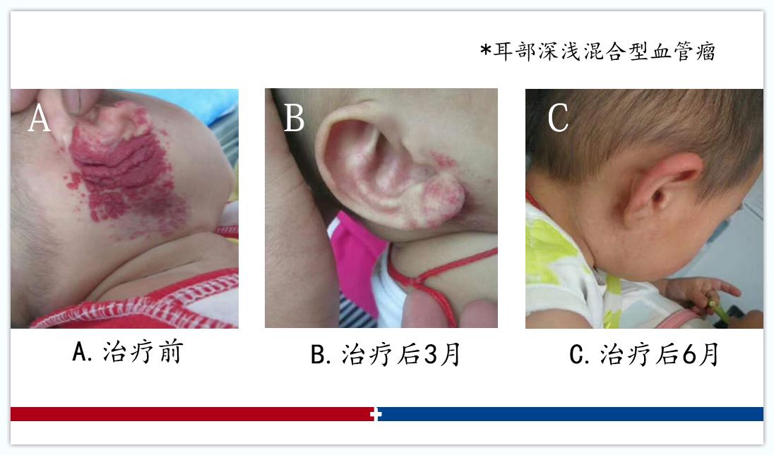 血管瘤复发的六大原因,血管瘤一直发作怎么回事