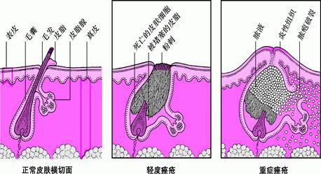 得了*疮痤**不要慌