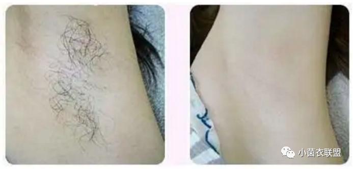 皮肤汗毛科普,皮肤疾病健康科普