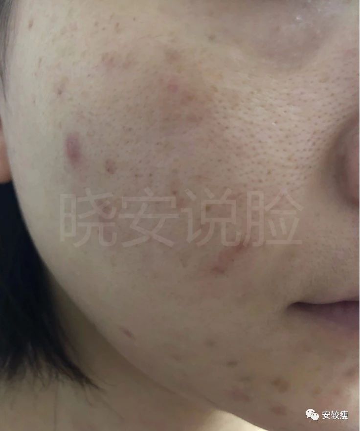 外油内干敏感痘肌怎么护肤,30岁油皮痘痘敏感肌怎么改善