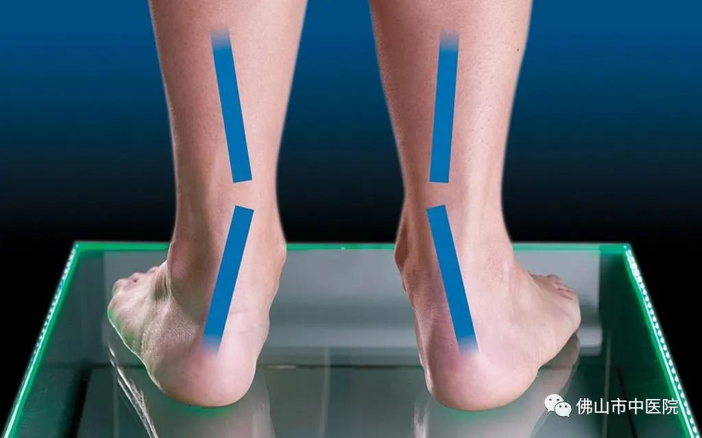 儿童扁平足的矫正训练,儿童矫正扁平足的最佳锻炼方法