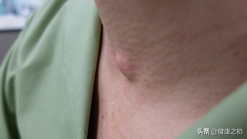 丘疹囊肿型痘痘具有反复性吗,囊肿型痘痘变软了是成熟了吗