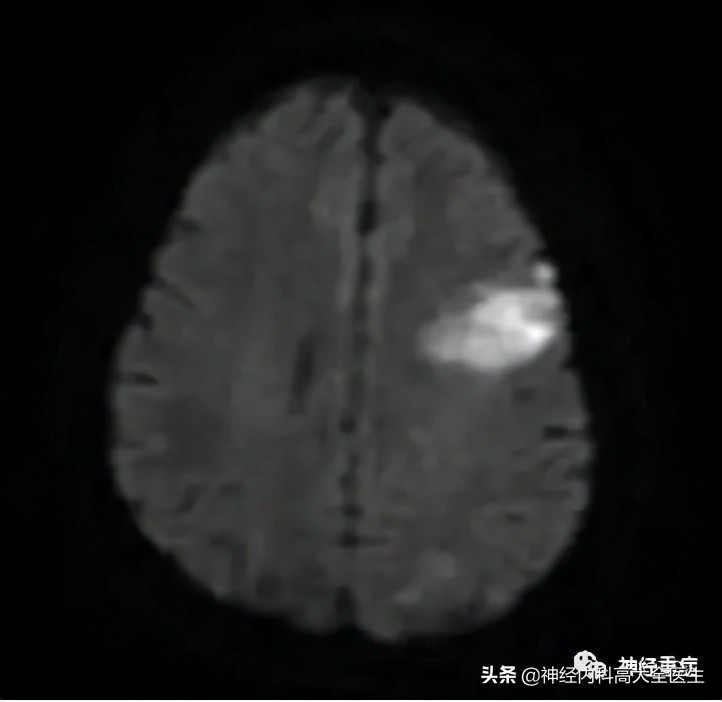 脑水肿是怎么形成,脑水肿和肾水肿的形成机制