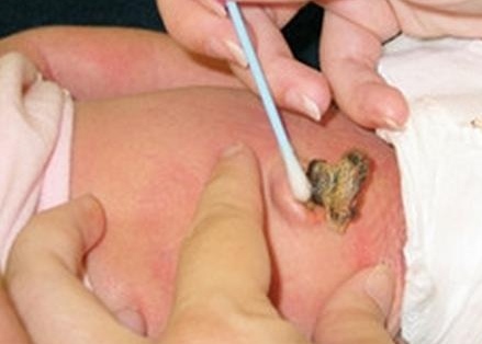 新生儿肚脐多久脱落21天,婴儿肚脐脱落后湿的怎么护理