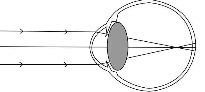 戴防蓝光眼镜真的可以预防近视吗,防蓝光眼镜有防治近视的效果吗