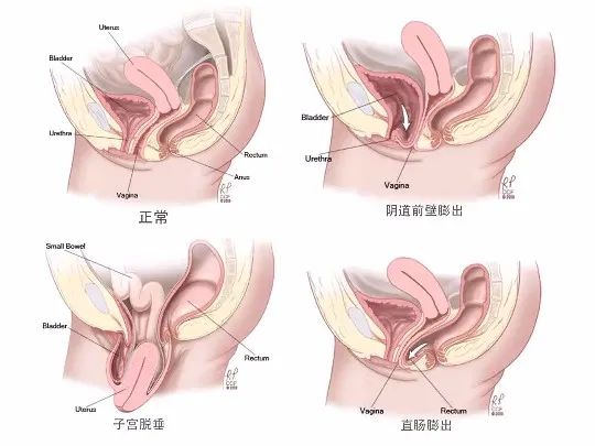 盆底肌真的可以治疗便秘,盆底肌跟便秘有关吗