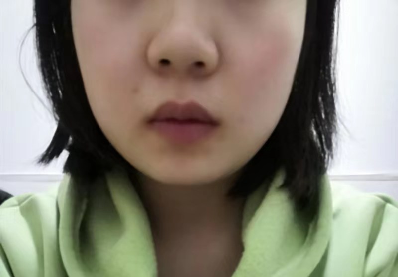 中药治疗腮腺炎、低热患者病案1例（1周）