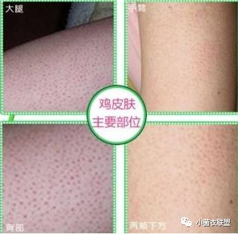 颈部毛囊上长疙瘩图片,大腿小腿毛囊很多红色凸起的小点