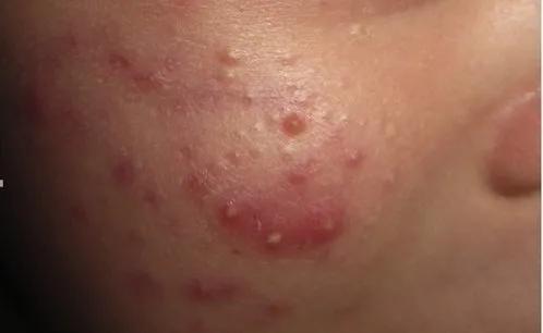 新生儿总是有红痘痘有白头,新生儿满月脸上长痘痘是怎么回事