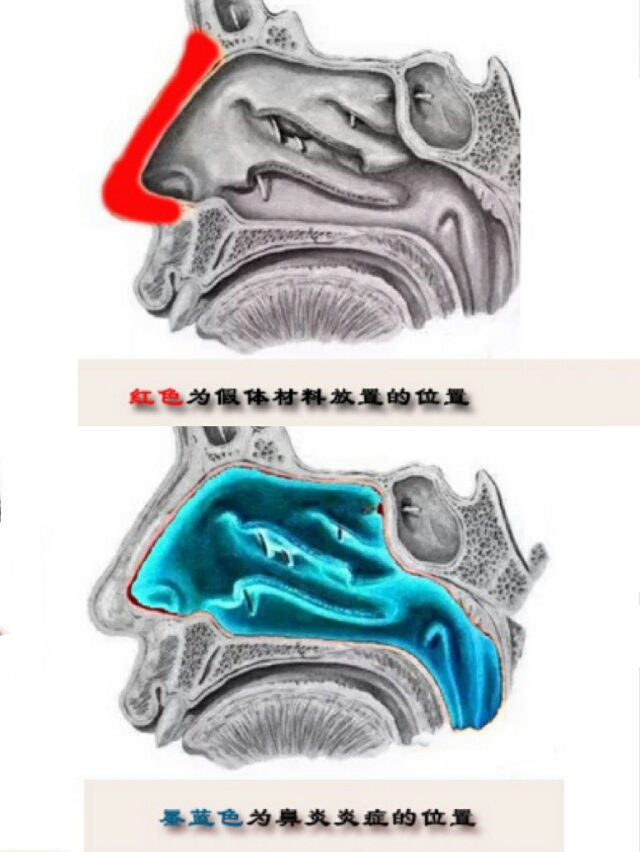 隆鼻好多年有鼻炎怎么办呢,有鼻炎的人做了隆鼻会怎样