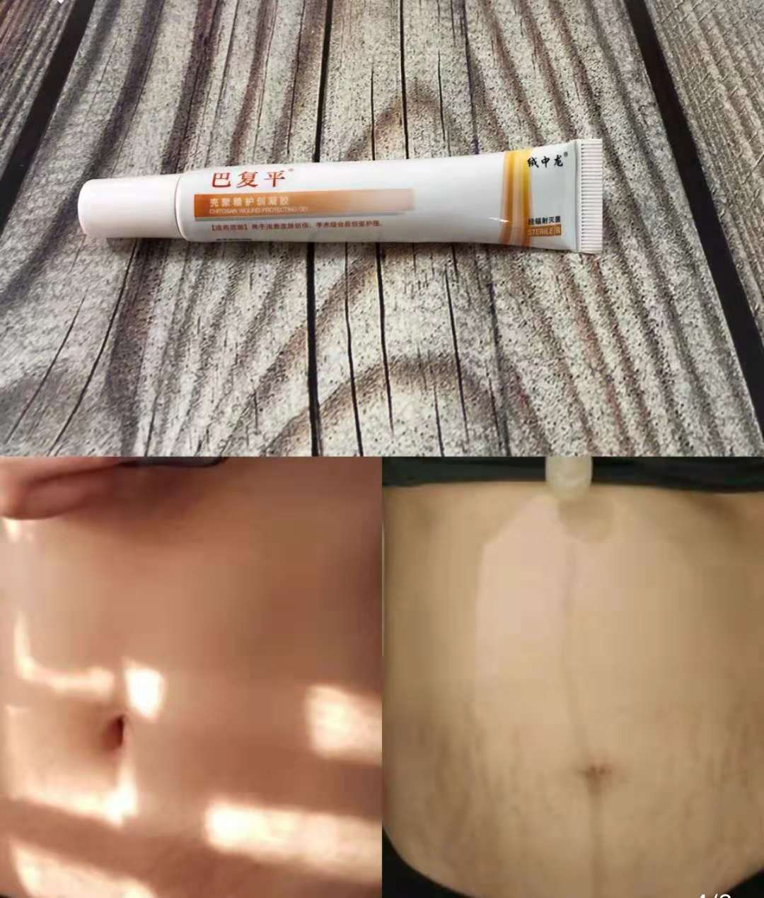 妊娠纹祛疤痕5年了最好的方法,去妊娠纹产后修复排行榜