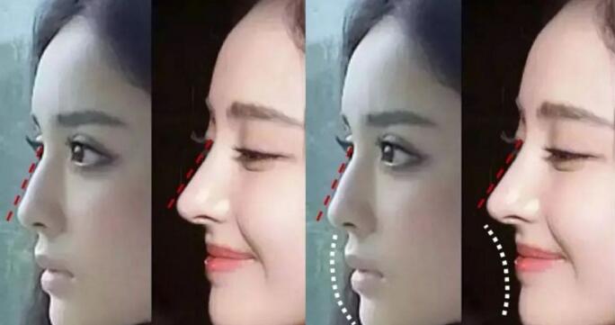 鼻子健康对五官的重要性,鼻子是决定颜值上限的部位