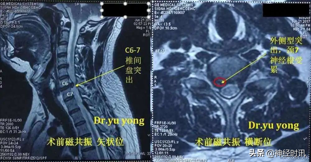 颈丛神经卡压症有什么表现怎么治,颈部神经卡压怎样松解视频