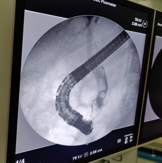 消化内镜技术近5年的新进展,腹腔镜下胆总管切开取石术恢复快