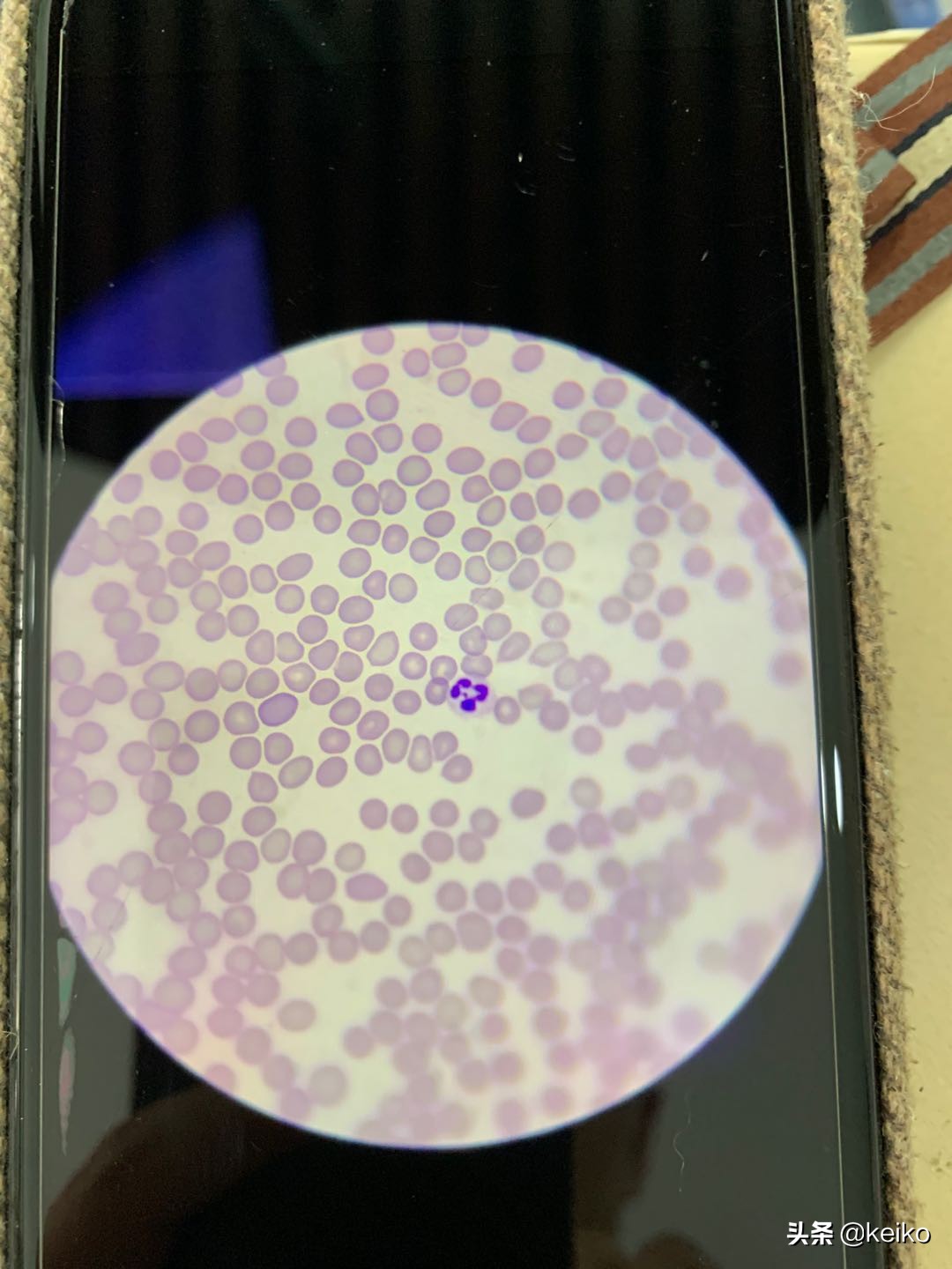 巴贝斯寄生虫治疗多久,巴贝斯寄生虫会传染人吗