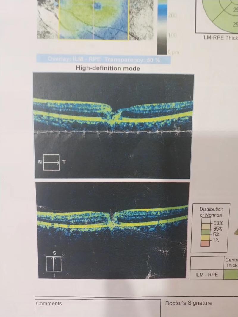 女大学生自购激光笔“洗”文身灼伤眼睛险失明