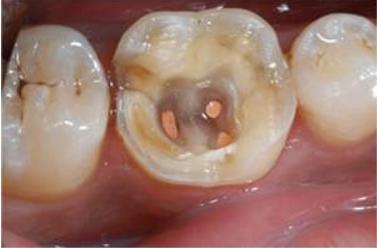 根管治疗是牙的什么问题,根管治疗真的是无法承受之痛吗